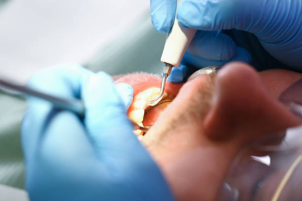 Best Emergency Treatment for Toothache in Toulon, IL