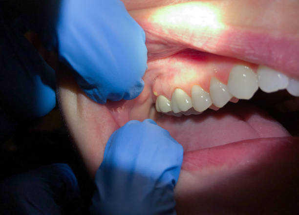 Best Emergency Tooth Extraction in Toulon, IL